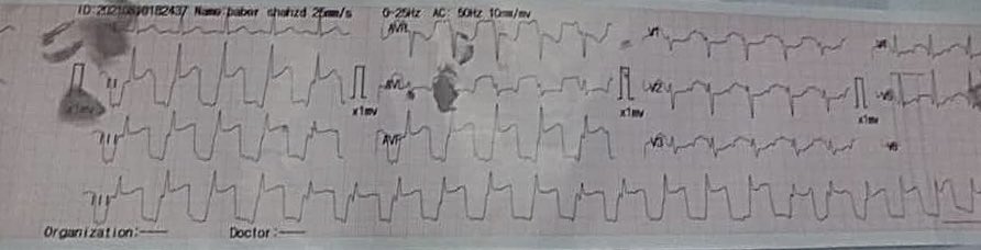 Dark69rd's tweet photo. A 27-year-old woman with 34 weeks of pregnancy presents with vertigo, dizziness, and epigastric discomfort. What is the diagnosis? #EPeeps #cardiologycases #cardiotwitter #ecghacks #medEd #medtwitter https://t.co/Y8uMoclEJ1