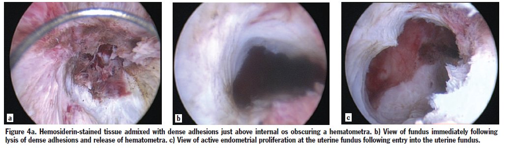 SurgicalTechSTI's tweet photo. Resectoscopic Surgery Part I:
Overcoming Obstacles and
Mastering the Basics, MORRIS WORTMAN, MD, FACOG
DOI: 10.52198/21.STI.38.GY1425 https://t.co/QZ7Csc4IN1