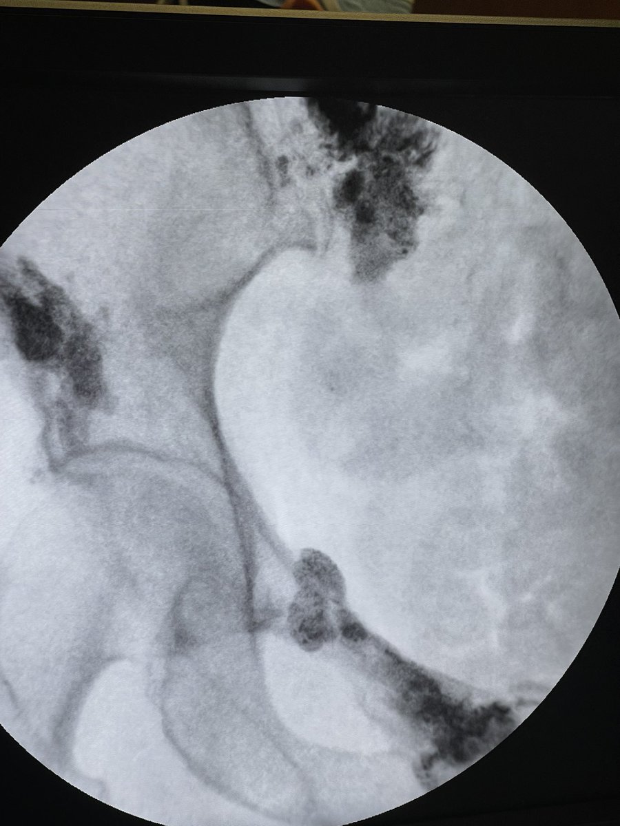 dougbeall's tweet image. A sacral fracture an ilium fracture and a superior pubic ramus fracture, why not treat all three at once? #boneaugmentation #3fer #insufficiencyfracture treatment. @SIRspecialists @ASIPP @ASPN_PainNeuro @ASBMR @OsteoporosisNOF