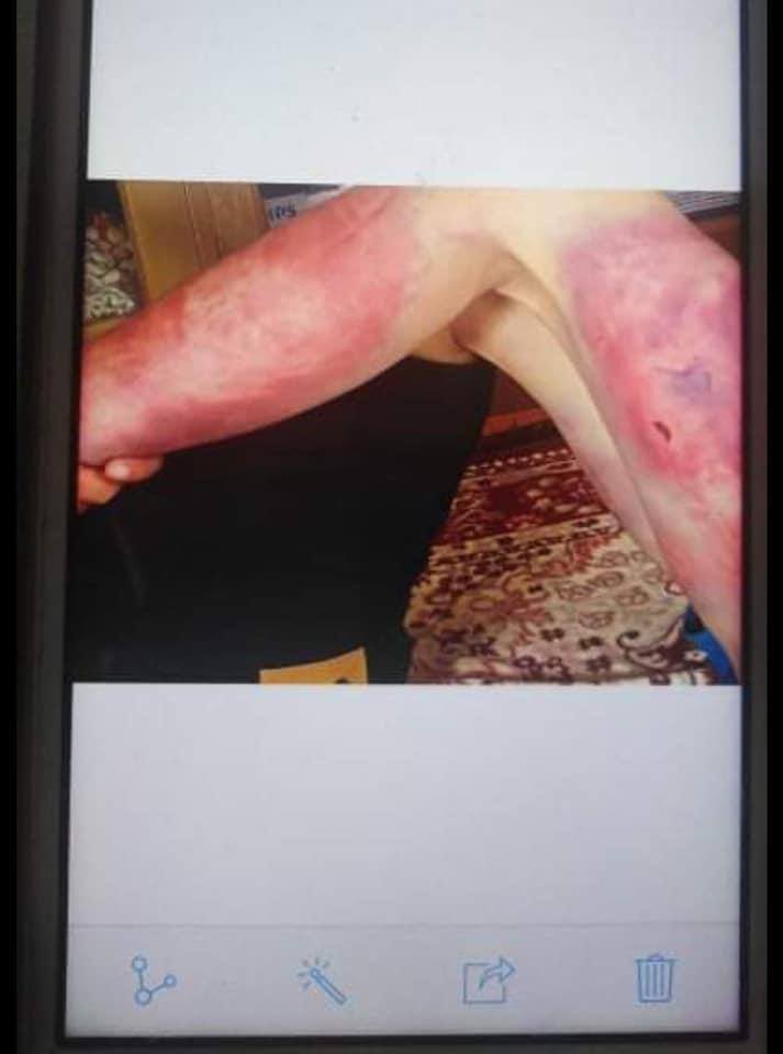 Haruonchill's tweet photo. On the night of Aug8, Junta Terrorists unlawfully ABDUCTED a civilian from PyiTawThar Ward in #TaungGyi city on alleged accusations of PDF member. The abductee was released on Aug9 but was brutally TORTURED in detention resulting in bruises. 
#Aug11Coup 
#WhatsHappeningInMyanmar https://t.co/pUJFvmc2pX
