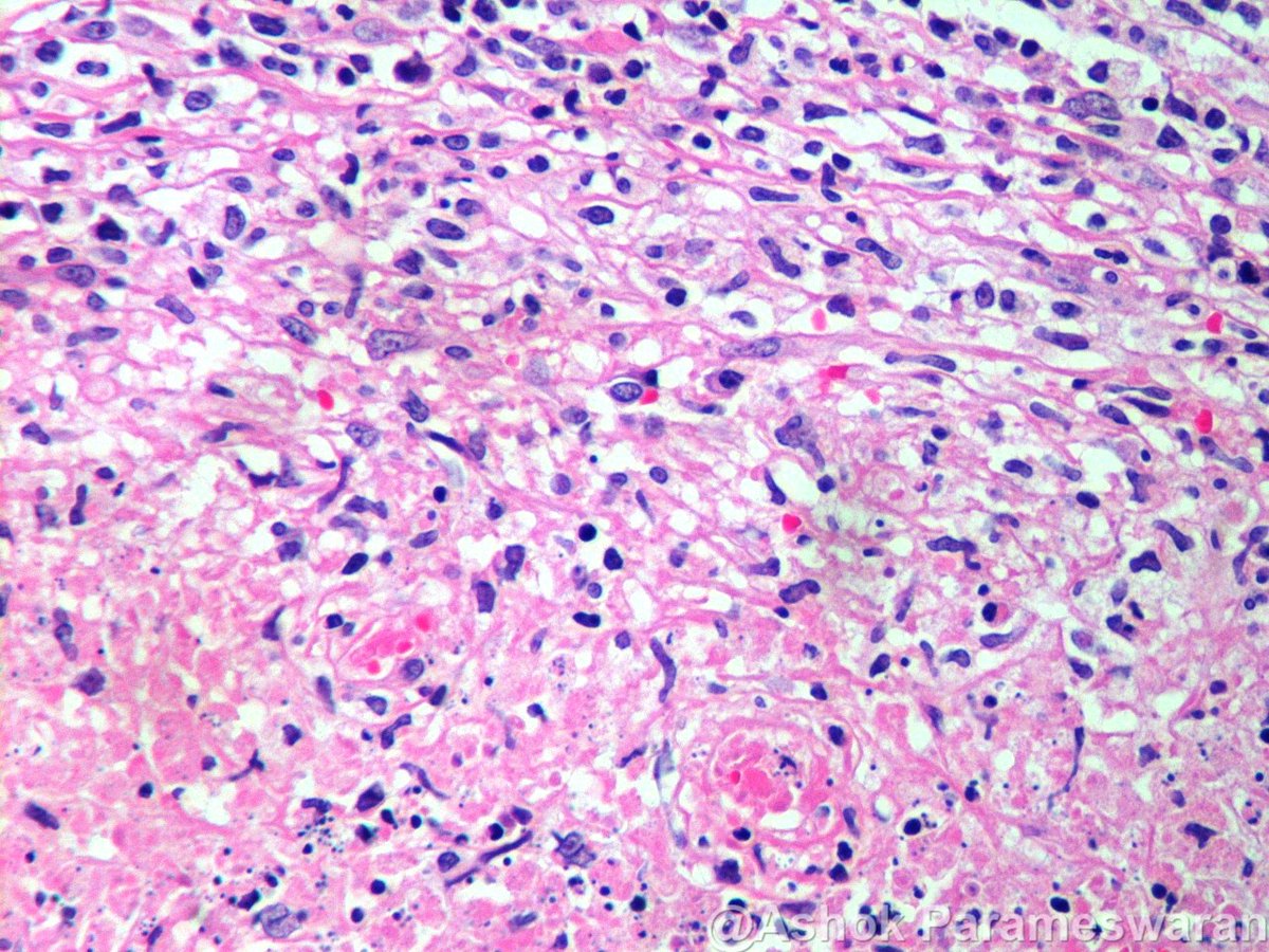 ashokparameswar's tweet photo. 27 year old lady, mild fever, hard neck nodes palpable. Lymph node biopsy performed. What is your diagnosis? https://t.co/1JdYLJNppo