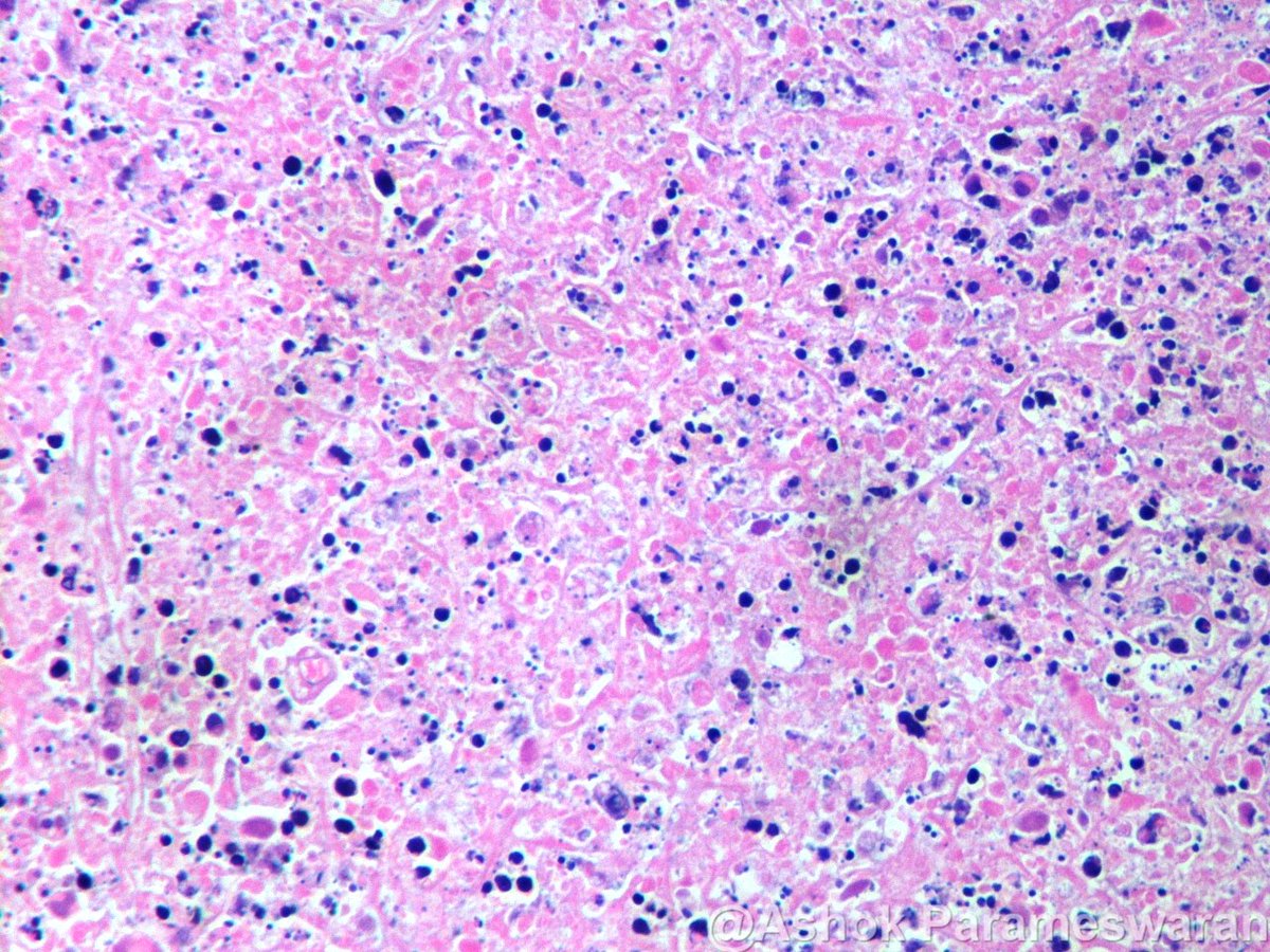 ashokparameswar's tweet photo. 27 year old lady, mild fever, hard neck nodes palpable. Lymph node biopsy performed. What is your diagnosis? https://t.co/1JdYLJNppo
