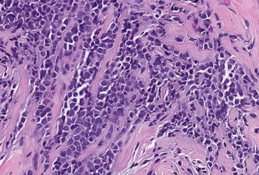 SibaElHussein's tweet photo. #LessonsfromtheFridayUnknowns myeloid sarcoma involving breast tissue shown to us by 
@ljmedeirosMD during #LJMFridayUnknowns 
✅Pitfall: Blastoid cells could be misinterpreted as high grade B-cell lymphoma, CD43 to the rescue➡️ https://t.co/KdAWEP81HI #hemepath #pathtwitter 🩸🔬 https://t.co/WF6IBQZiQc