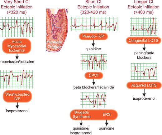 SeguraCardio's tweet photo. 📌Initiation &amp; management of polymorphic ventricular tachycardia #ePeeps #CardioEd #CardioTwitter https://t.co/bmVlHqG81y
