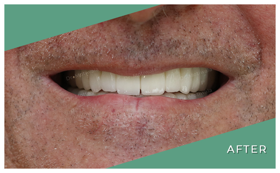 drmotiwaladcic's tweet image. It only takes a split second to SMILE and forget, yet to someone that needed it, it can last a lifetime.

#fullmouthdentalimplants with NexxZrZirconia bridge

#permanentteethin3days #immediateloadingimplants #singlepieceimplant #basalimplants #nexxzrzirconiacrowns #trateag