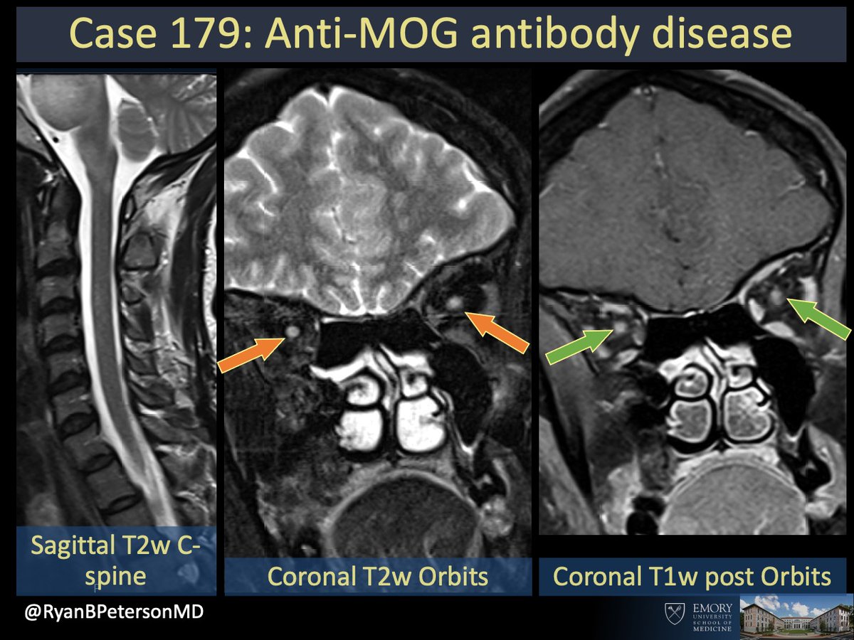 emory-radiology-cotd-179-hx-young-adult-bilateral-vision-loss-no