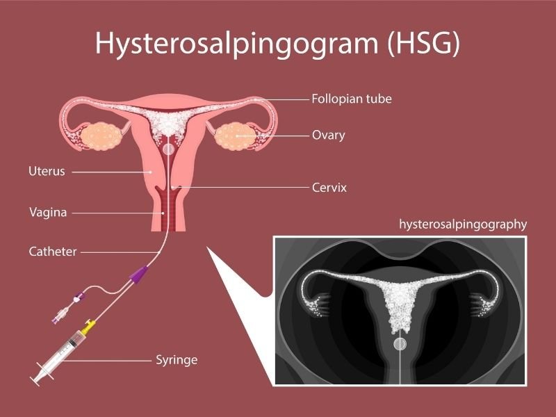 BansalIvf's tweet image. Hysterosalpingography, or HSG test is an X-ray test to stipulate the interior shape of the uterus and show whether the fallopian tubes are blocked.

bansalhealthsquare.com/what-is-hsg-te…

#hsg #hsgprocedure #hsgtest