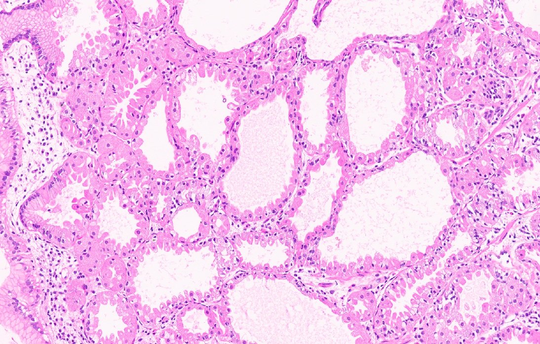 vij_mukul's tweet photo. Gastric polyps. Beauty in Benign. #GIpath #PathTwitter https://t.co/7RTQILXLJ9