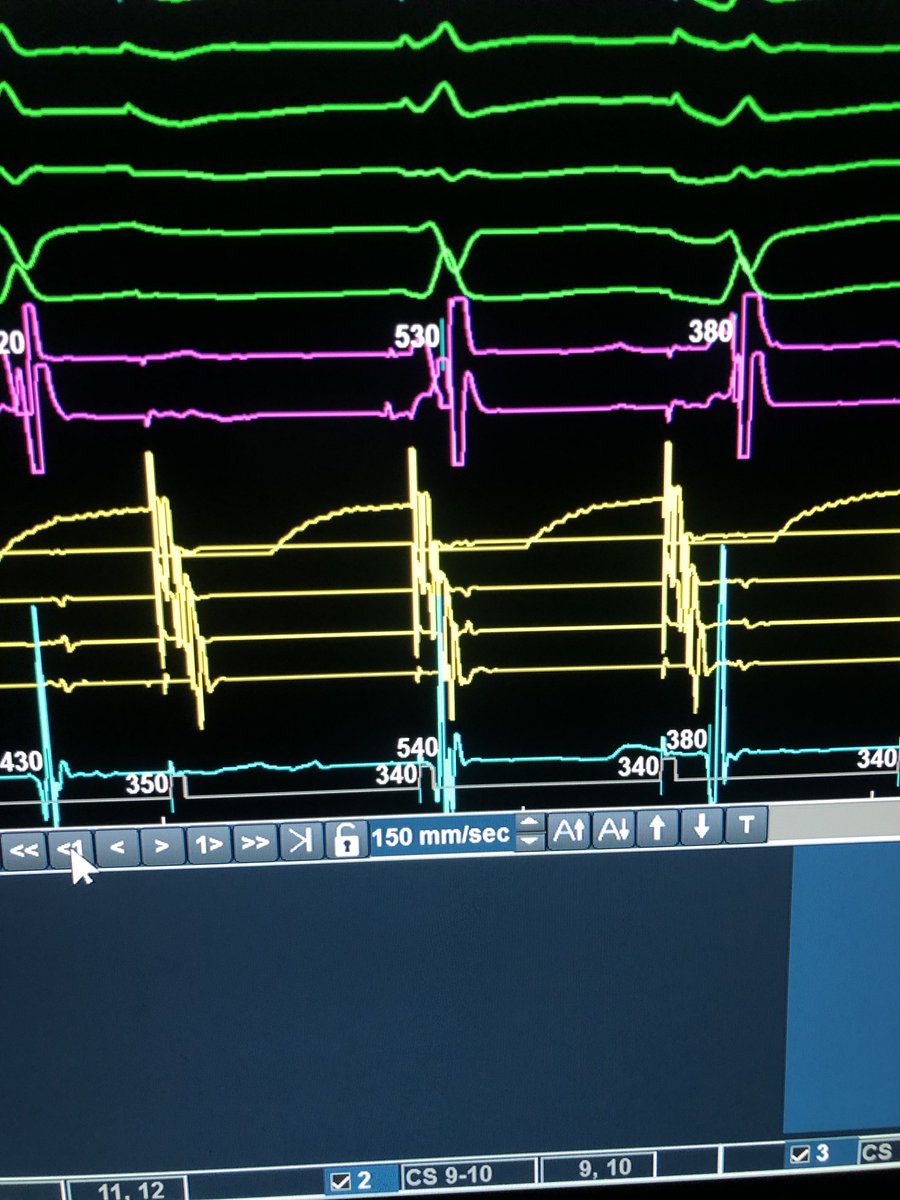 Echo beat is an beat that conducted retrograde in fast pathway to the Atrium and antegrade in slow pathway to the ventricle in the same time. 
#EPS