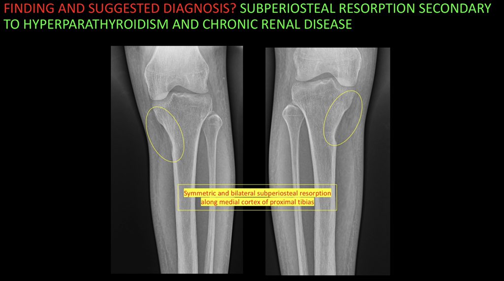 amfischer89's tweet photo. Case 21- SUBPERIOSTEAL RESORPTION IN HYPERPARATHYROIDISM. See attached teaching points. Enjoy! @ufjaxrads #FOAMed #FOAMrad #radiology #MSKRad #radres #futureradres #MedEd #medtwitter #orthotwitter @SSRbone @ssr_rwg @KurraChandana https://t.co/FL8ODl4Dan