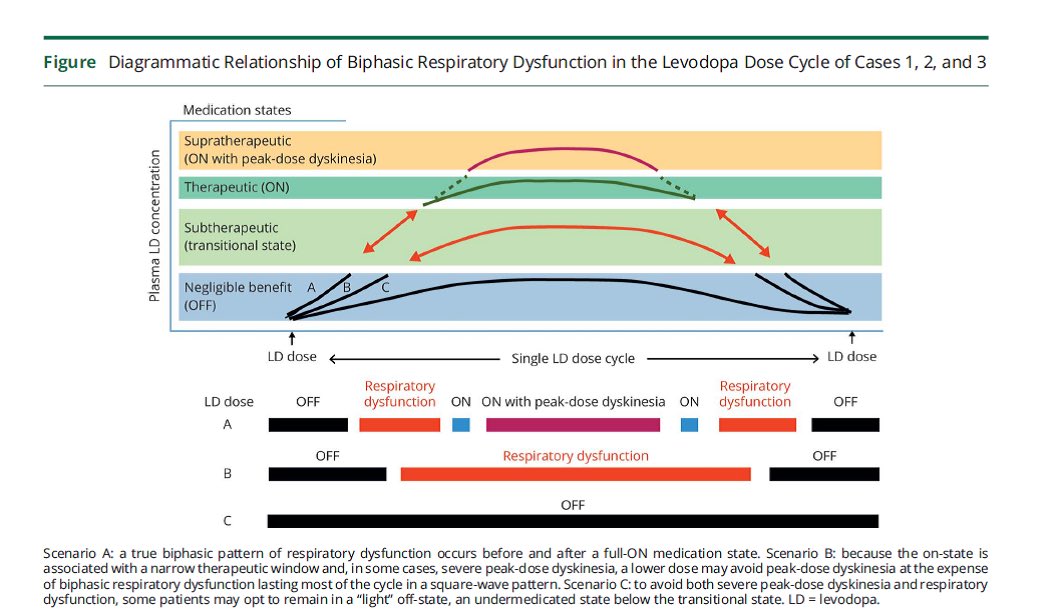 basbloem's tweet photo. 2/2 #Biphasic dyskinesias in #Parkinson means that this adverse effect is most prominent when #levodopa is only half effective (see figure for explanation). These biphasic dyskinesias are treatable, so timely recognition can have important therapeutic consequences. https://t.co/QHMib8NRh2