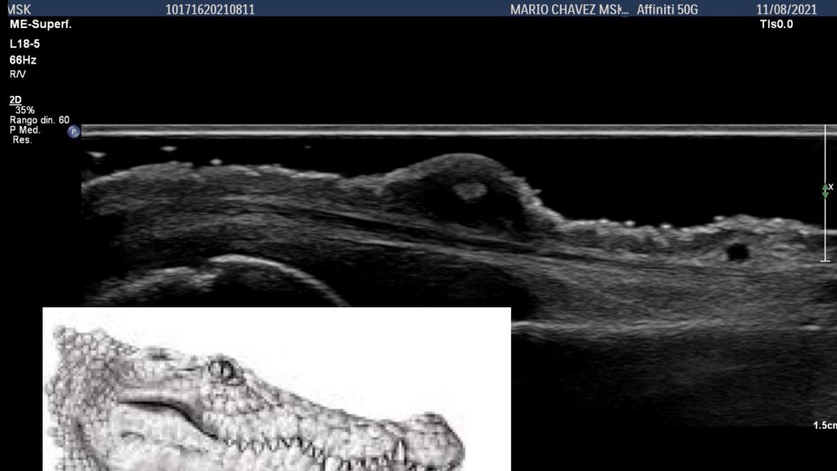 Crocodile 🐊 !!! 👀👀😮<a href="/morrisonMSK/"> William Morrison, MD</a> <a href="/Merayo_Dr/">Javier Merayo-Chalico</a> <a href="/DianaReuma/">Diana_reumatika</a> <a href="/reumacia/">Cristina Macía</a> <a href="/PhilipsPOCUS/">Philips POCUS</a> <a href="/mskusmastermind/">MSK ULTRASOUND MASTERMIND®</a> <a href="/ReumaEco/">Ecografía en Reumatología</a> <a href="/ReumaIntegral/">𝙳𝚛𝚊. 𝙰𝚗𝚊 𝙻𝚊𝚞 🇲🇽</a> <a href="/CrusSurc/">CRUS-SURC</a> <a href="/drrheumatocito1/">Dr. Mendoza Torres</a> <a href="/Rheumatology/">Sᴡɪss Uʟᴛʀᴀsᴏᴜɴᴅ Cᴇɴᴛᴇʀ - UZR</a> <a href="/MGH_MSUS/">MGH Rheumatology MSK Ultrasound Program</a> <a href="/GSERRANOB_MSK/">Gonzalo Serrano-Belmar.</a> <a href="/MSKUS_PT_KSA/">Abdulwahed AL zaher</a> <a href="/mskultrasound/">The Ultrasound Site - MSK ultrasound training</a> <a href="/NU_Rheum_MSK_US/">Arthur Mandelin, MD/PhD, RhMSUS, RMSK</a> <a href="/Joao_rheumaMSK/">João Freitas, MD</a> <a href="/MSK_Australia/">MSK Australia</a> <a href="/LuchoRDbo/">Luis C. Rodriguez RheuMsk</a>
