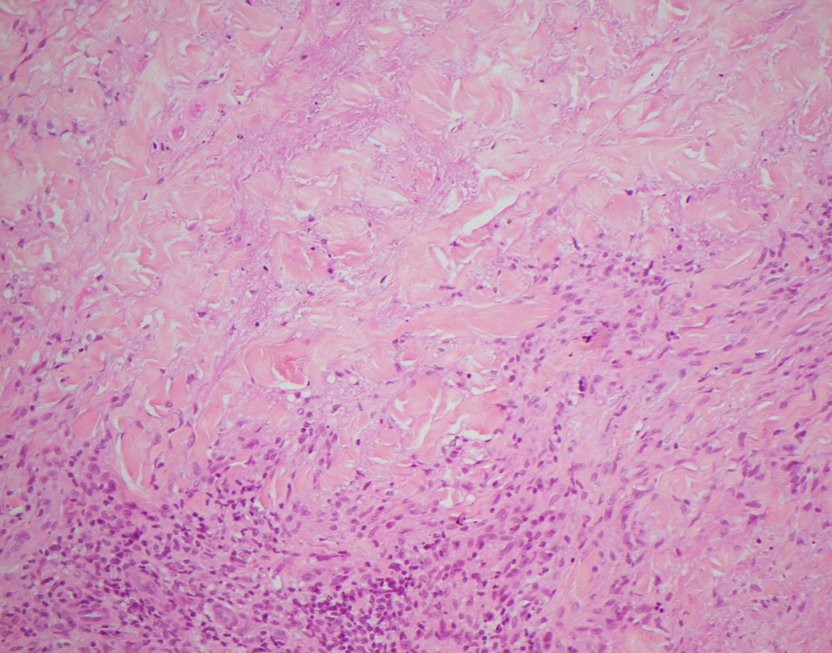 CaDxPath's tweet photo. Of course being from the 'Cancer Diagnosis and Pathology' https://t.co/k6NRw4NAXQ group we are most interested in cancer diagnosis and pathology.

But good to do some non-neoplastic pathology too.

Plaques on the shins of a young patient with type 1 diabetes?

Answer below: https://t.co/0QwptlNveA