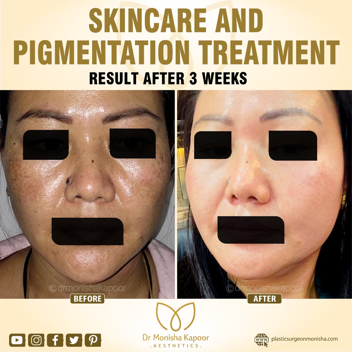 As can be seen in the picture, this patient of ours was dealing with dark spots on her face. A combination of treatments was used to address her concern and lighten these spots.
Call us on 91- 9811439395, 8373984777, 8860851727

#pigmentation #pigmentationremoval #TwitterFont