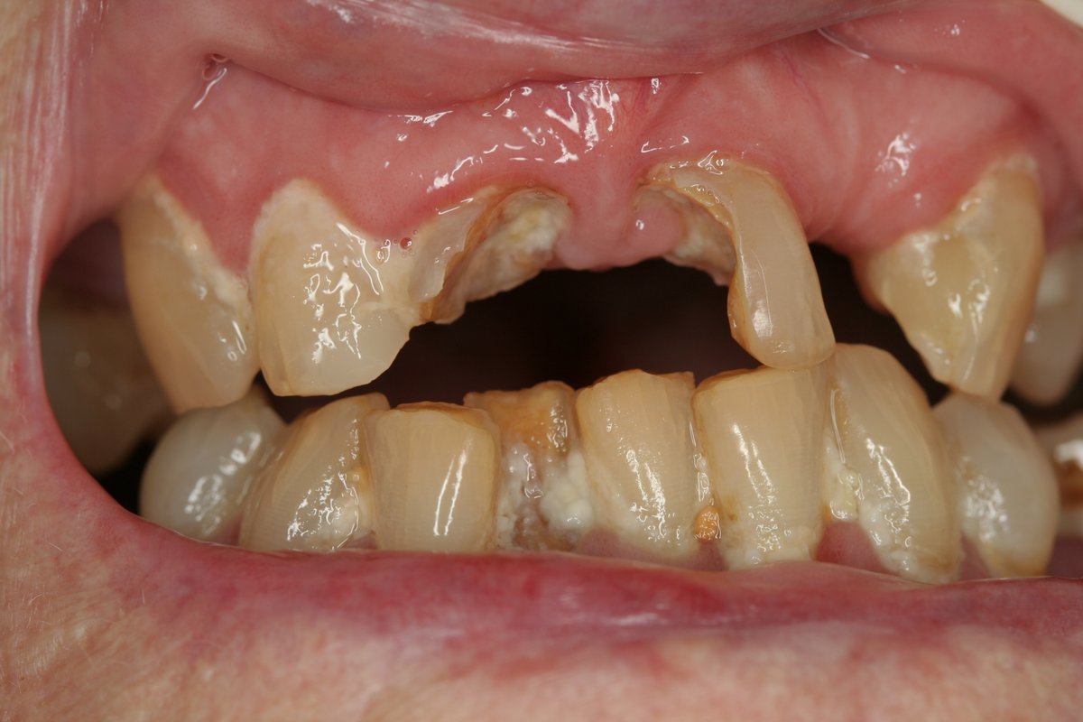 Matt_Hopcraft's tweet photo. Residents in aged care facilities have limited access to dental services &amp; experience poor oral health. The Aged Care Royal Commission recommending establishing a Medicare Seniors Dental Benefits Scheme to improve access for this vulnerable group.
@drjanetwallace @Mark_Butler_MP https://t.co/LE20lF7WHf