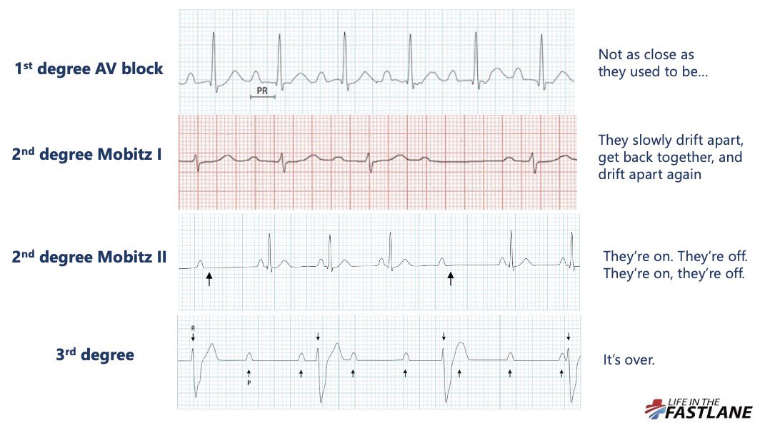 Struggling to remember heart blocks? It’s just a relationship falling apart. 👫👭👬 #FOAMed