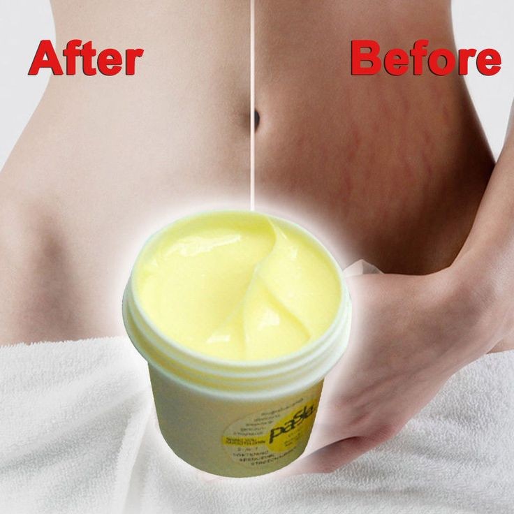 laiiquinx's tweet image. 🌻 Pasjel Body Cream 🌻
— 160 pesos only!!

Remove those stubborn stretch marks! Feel and look fresh again.💁🏻‍♀️

Hurry and get yours! 
Available on pre-order!📩

#LegitDistributor #LegitOnlineBusiness #skincare #preciousskinthailand