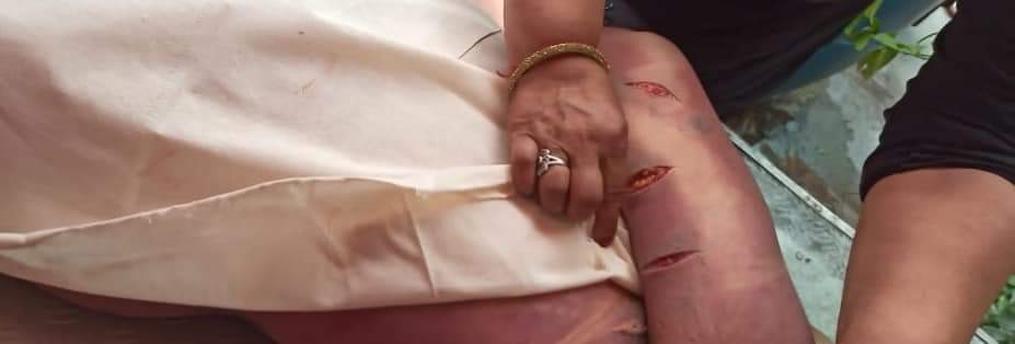 Reportersubhan's tweet photo. @TelanganaDGP @KTRTRS @RachakondaCop  newly wed Shaheen begum Murdered at Balalpur police station limits and convert in the suicide story of hanging..
This is the mark of Hanging...?
Before one year this family killed his own daughter like this and convert in to Suicide story.. https://t.co/abwrbP590H