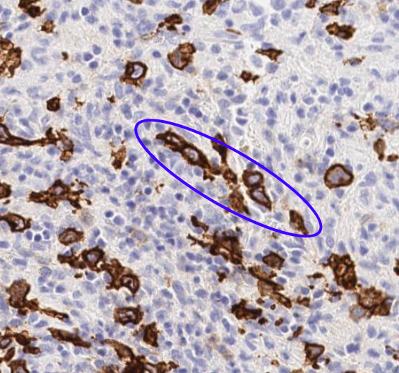 SibaElHussein's tweet photo. #LessonsfromtheFridayUnknowns CHL demonstrating numerous Hallmark-like cells and a sinusiodal pattern of infiltration shown to us by @ljmedeirosMD during the #LJMFridayUnknowns➡️https://t.co/3iqE5XtbNa

#hemepath #PathTwitter #lymsm 

@KirillLyapichev @RMirandaMD @Xiaoqiong_Wang https://t.co/fU825dtofz