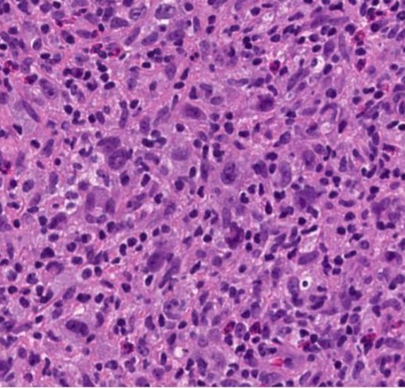 SibaElHussein's tweet photo. #LessonsfromtheFridayUnknowns CHL demonstrating numerous Hallmark-like cells and a sinusiodal pattern of infiltration shown to us by @ljmedeirosMD during the #LJMFridayUnknowns➡️https://t.co/3iqE5XtbNa

#hemepath #PathTwitter #lymsm 

@KirillLyapichev @RMirandaMD @Xiaoqiong_Wang https://t.co/fU825dtofz