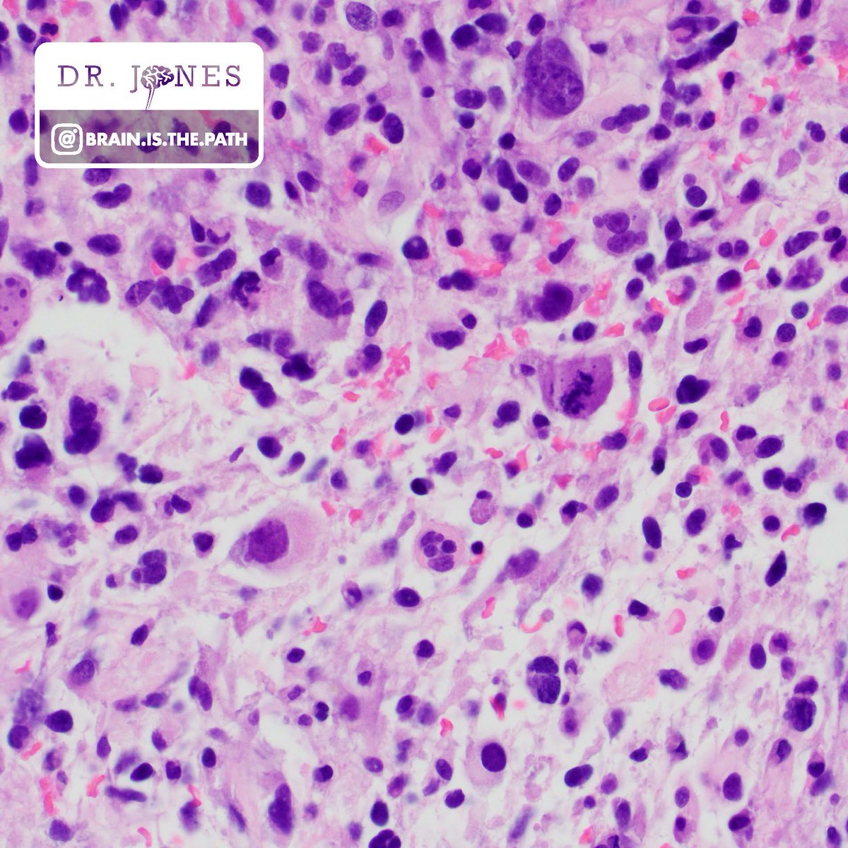BrainIsThePath's tweet image. Let's work through a case together! Young adult with hemispheric brain mass with post-contrast enhancement. 
1. What is your histologic diagnosis
2. What IHC and/or molecular tests should we consider when we see this specific histopathology?
#neuropath @UIPathology