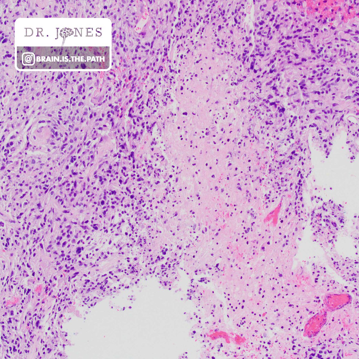 BrainIsThePath's tweet image. Let's work through a case together! Young adult with hemispheric brain mass with post-contrast enhancement. 
1. What is your histologic diagnosis
2. What IHC and/or molecular tests should we consider when we see this specific histopathology?
#neuropath @UIPathology
