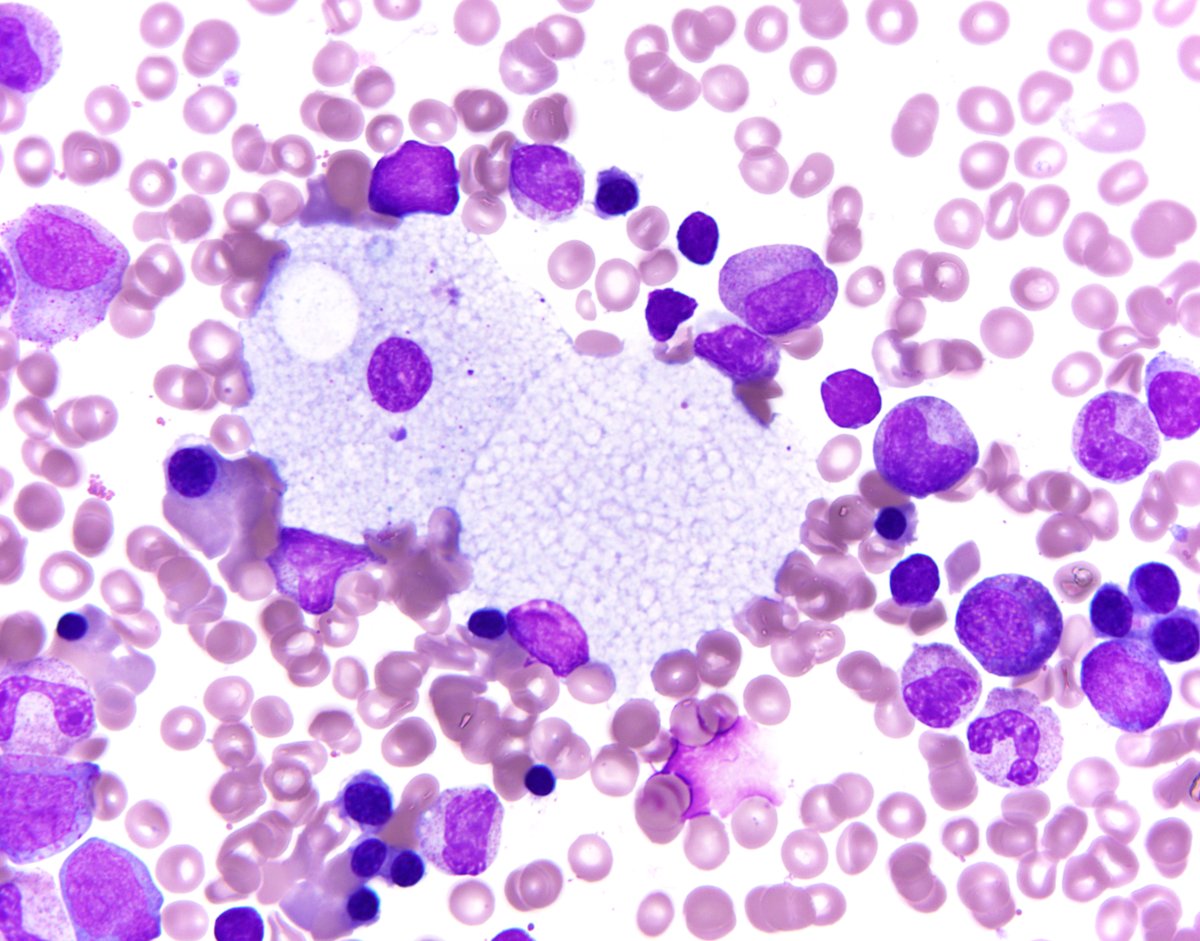 Bone marrow involvement in Niemann Pick disease - 1.