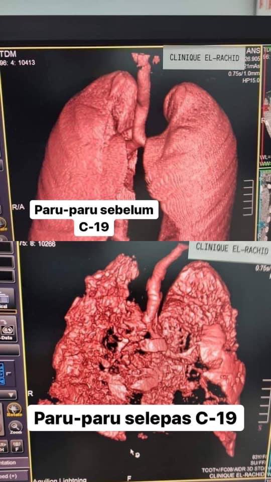 Sangat bahaya guys virus ni ,pergilah ambil vaksin ,siapa yg dah cukup dua dos tu tunjuk peace ✌🏻