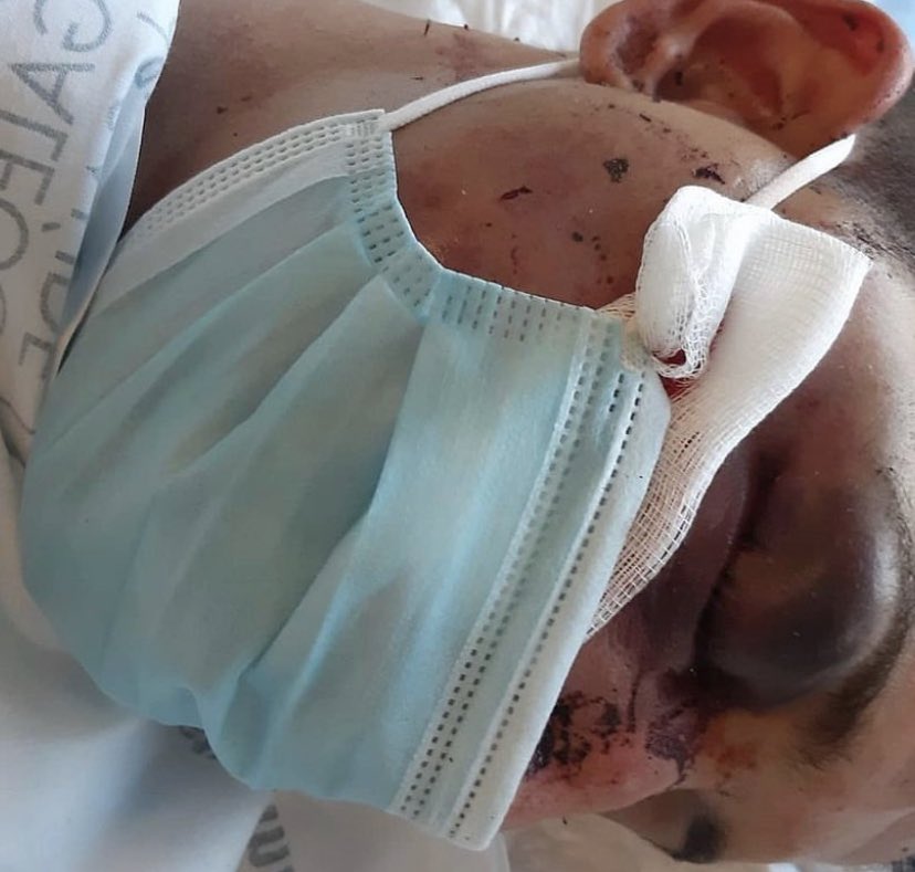esdecirdiario's tweet photo. Nacho, de 25 años, fue víctima de una brutal agresión grupal en Nigrán.

Al menos 6 personas le propinaron golpes, dejándolo malherido.

Lleva un año sin salir de casa con secuelas difíciles de superar y sus agresores, en cambio, todavía no han pagado por lo que han hecho. https://t.co/bgm4hsHgzX