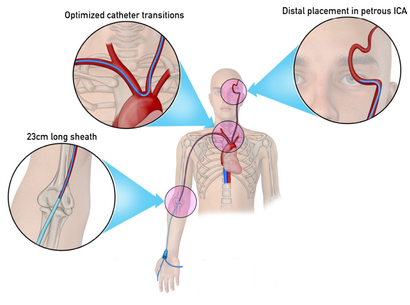 JNIS Latest Content
<a href="/drjoshabecassis/">Isaac "Josh" Abecassis, M.D.</a> et al report the RIST system in 152 transradial neurointerventions #RadialForNeuro
@brianwalcottMD <a href="/trpeebles/">Todd Peebles</a> @Starke_neurosurgery <a href="/VSainiMD/">Vasu Saini</a> <a href="/JustinSingerMD/">Justin Singer MD, FAANS</a> <a href="/JOsbunMDxCV/">Joshua Osbun</a> <a href="/bainmd/">Mark Bain, MD, MS</a> <a href="/CStoreyMDPhD/">Christopher Storey</a> <a href="/dyavagal/">Dileep R. Yavagal</a> <a href="/braincutter/">Eric Peterson</a>
bit.ly/37C73Ih
