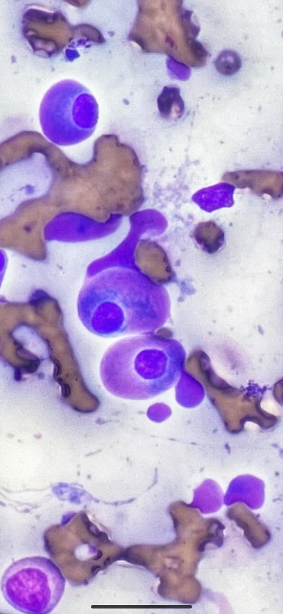 ErinGarrettMD's tweet photo. Flame cells 🔥 typically associated with IgA multiple myeloma https://t.co/gTpGVyxJKo