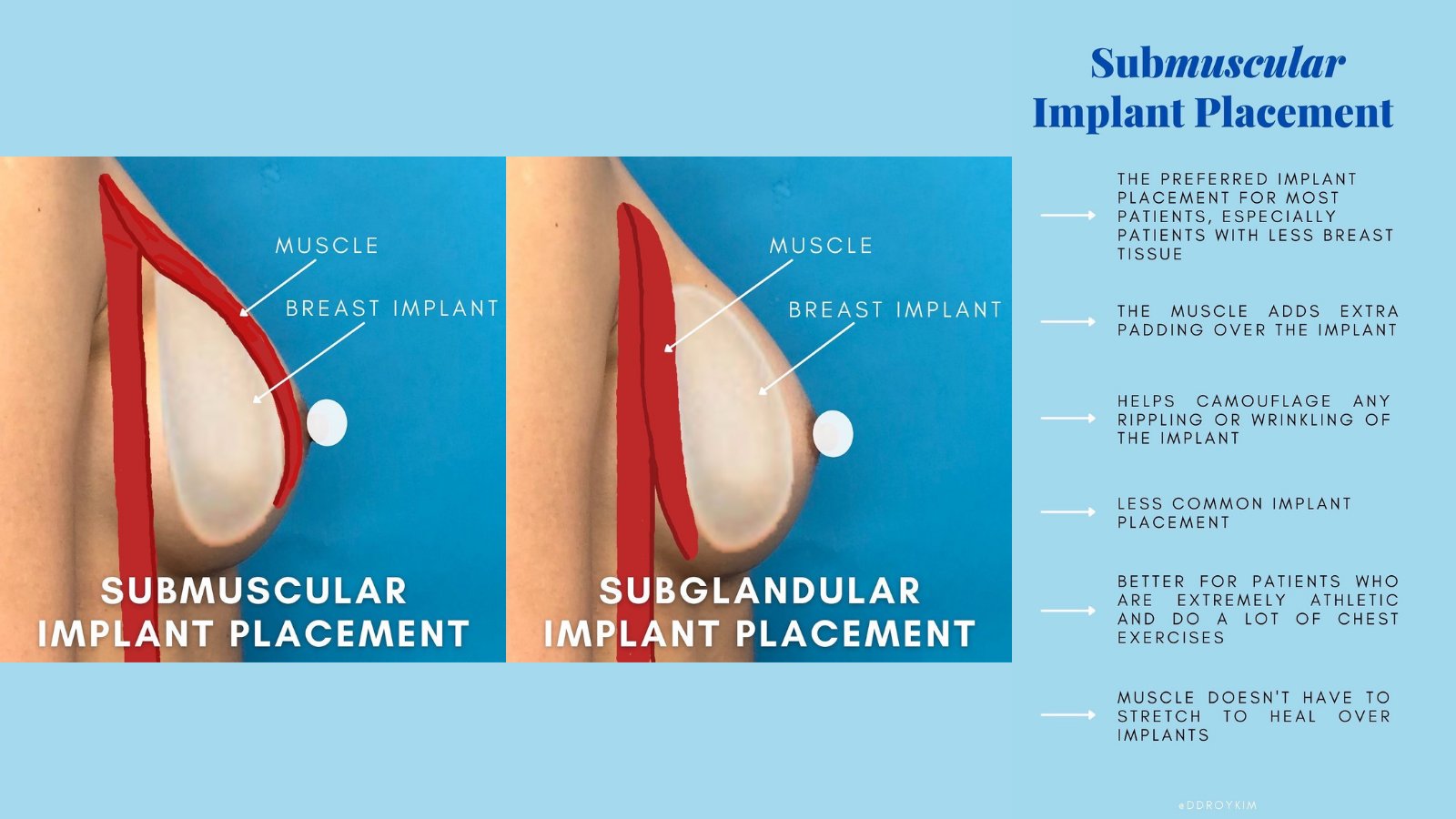 Roy Kim 🇺🇸 on X: There are two common breast implant placements