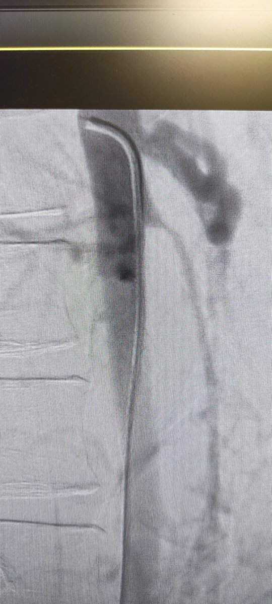 Arteritis de Takayasu