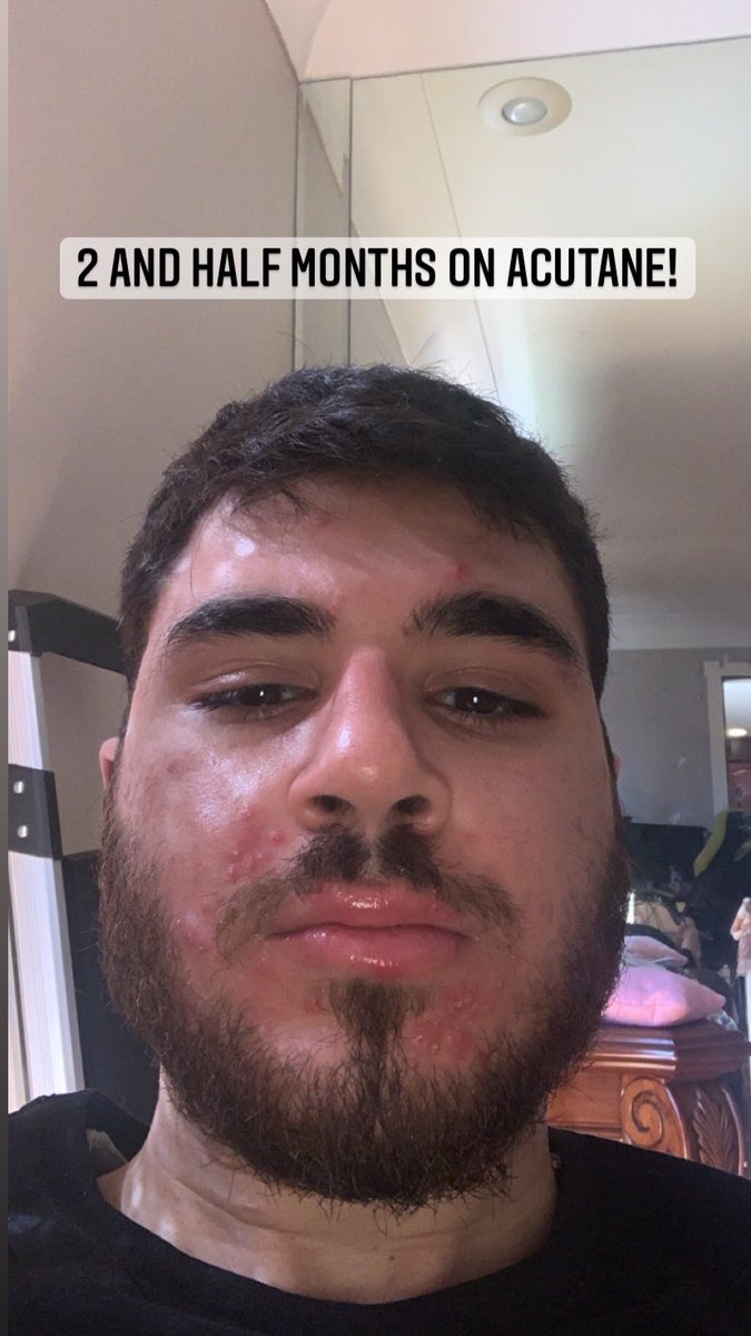 senseiizer0's tweet photo. I used to never sleep at night my back was getting worse everyday i would wake up with new pimple and not regular ones they were cystic hurt a lot..one day i said enough is enough i decided to take this med called acutane it was so worth it so heres a glow up! #acutane https://t.co/1qy3Fu5fMK