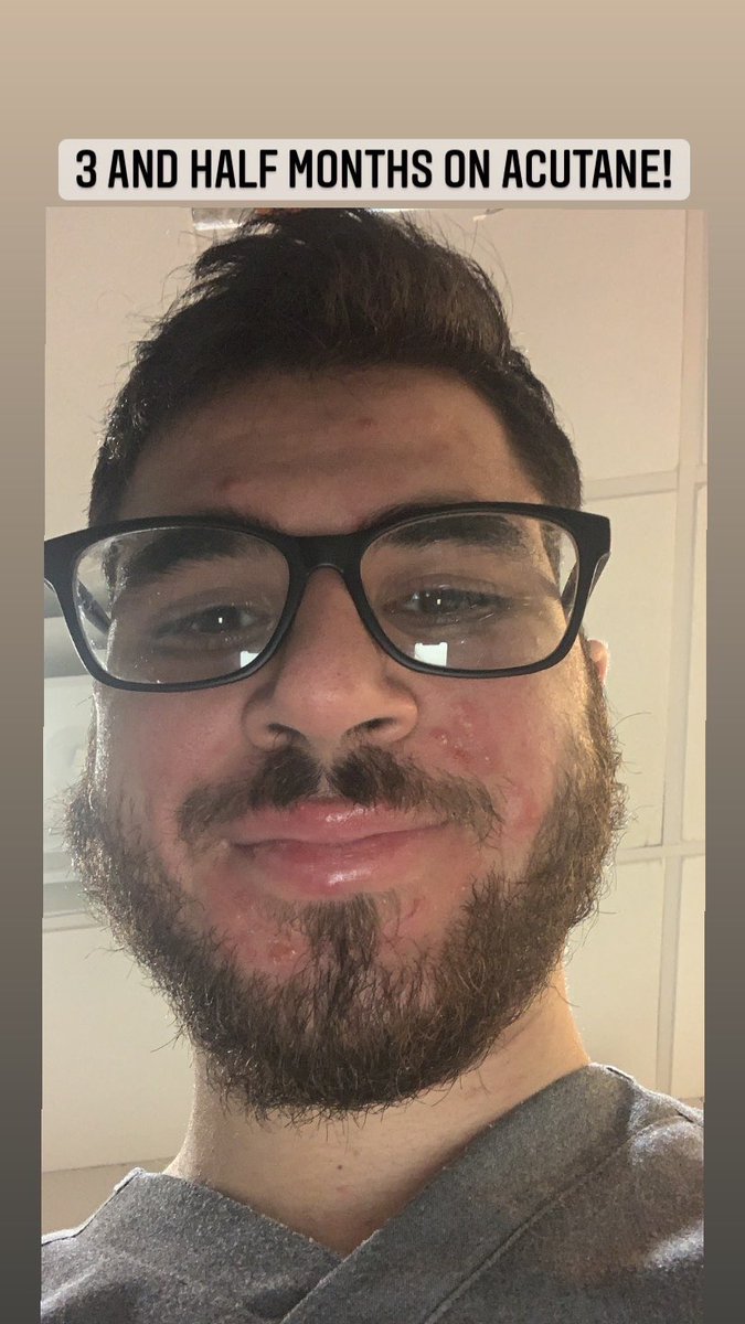 senseiizer0's tweet photo. I used to never sleep at night my back was getting worse everyday i would wake up with new pimple and not regular ones they were cystic hurt a lot..one day i said enough is enough i decided to take this med called acutane it was so worth it so heres a glow up! #acutane https://t.co/1qy3Fu5fMK
