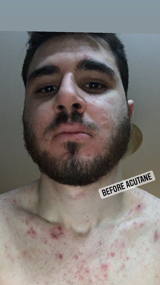 senseiizer0's tweet photo. I used to never sleep at night my back was getting worse everyday i would wake up with new pimple and not regular ones they were cystic hurt a lot..one day i said enough is enough i decided to take this med called acutane it was so worth it so heres a glow up! #acutane https://t.co/1qy3Fu5fMK
