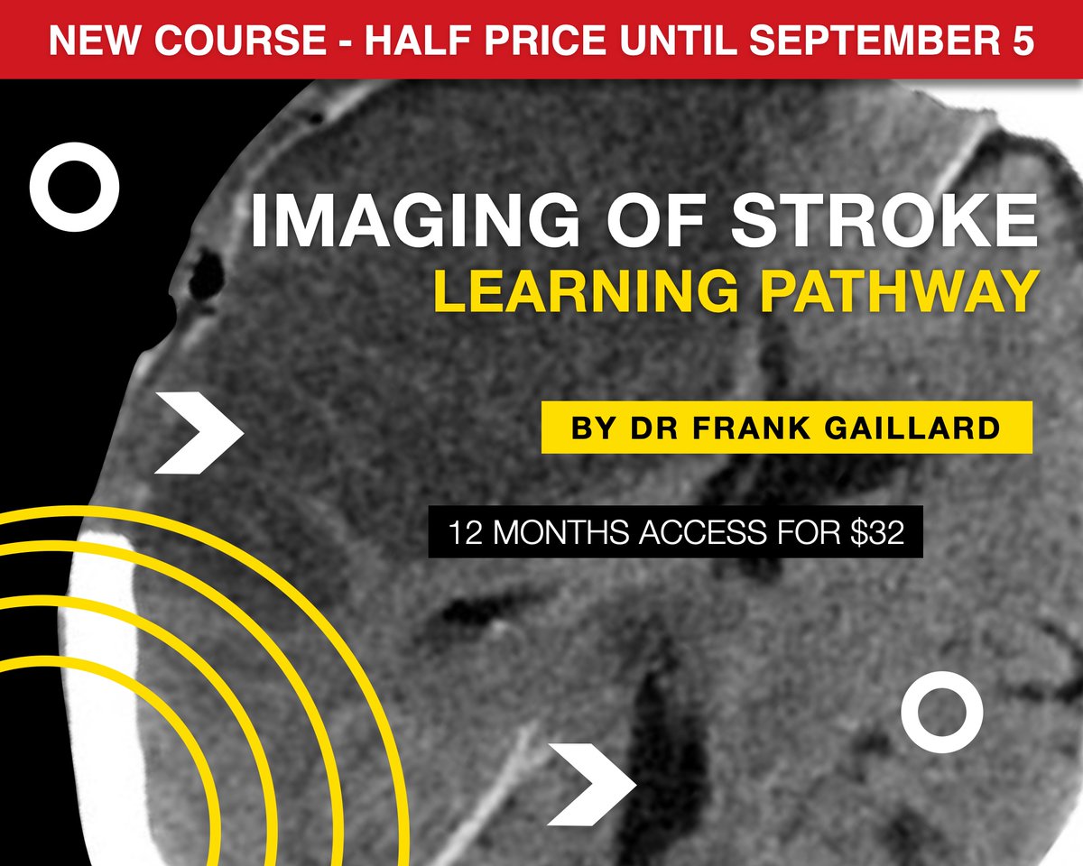 frankgaillard's tweet image. Sneaky pre-announcement: NEW stroke learning pathway on @Radiopaedia  has just landed!  Expect more promotion, but you heard it here first :)