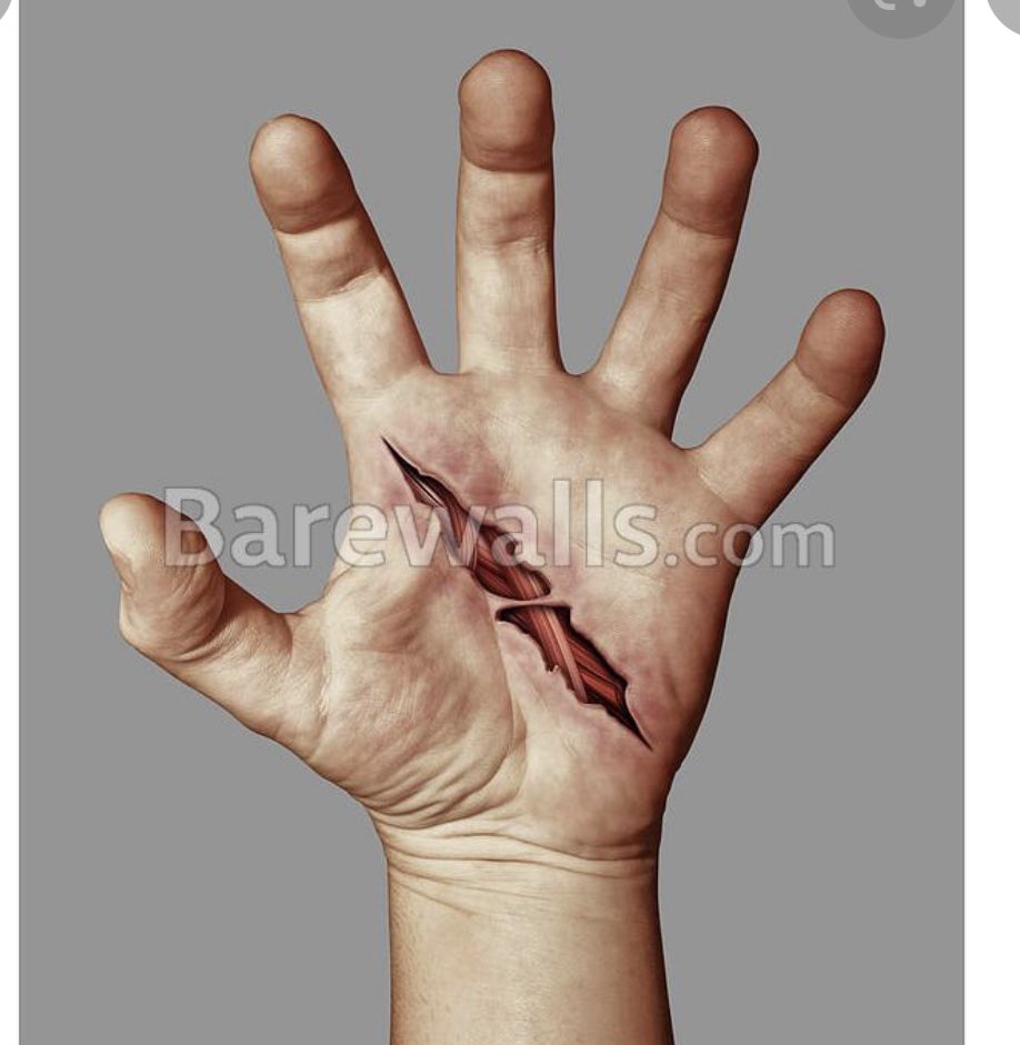 DrAlkhodairy's tweet photo. من الحوادث المنزلية جروح باذن اليد بسبب غسل كوب او كأس مكسور الحافة(مثلوم أو منثلم بالعامية)فإذا كان لديك هذا الكوب او الكأس فأرمه في اقرب نفايات ولو كانت الحافة فقط مكسورة ولا تبخل به لأنه قد يقوم احد افراد عائلتك بغسله فتحدث مثل هذه الجروح 👇🏾 https://t.co/kQ9x1QR3X5