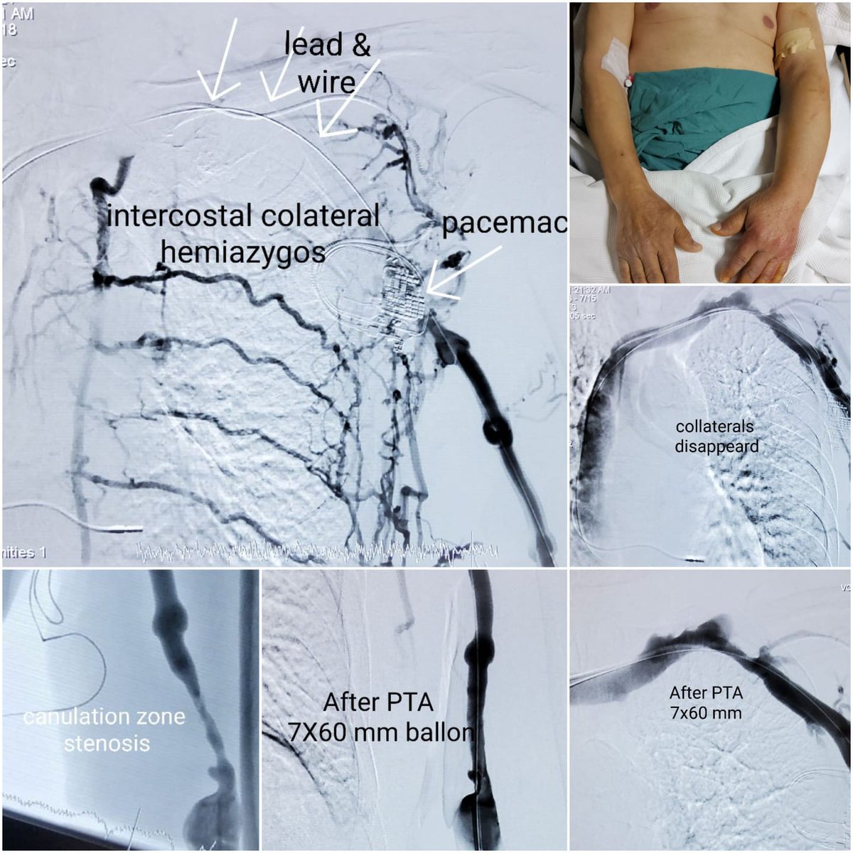case of the day.pacemaker and left brachiocephalic fistula. swelling in the left arm. total lead vein entry site.hemiazygos -intercostal vein collateral flow completely disappeared after PTA procedure. My first case of fistula vein stenosis caused by pacemaker.#fistula #pacemaker