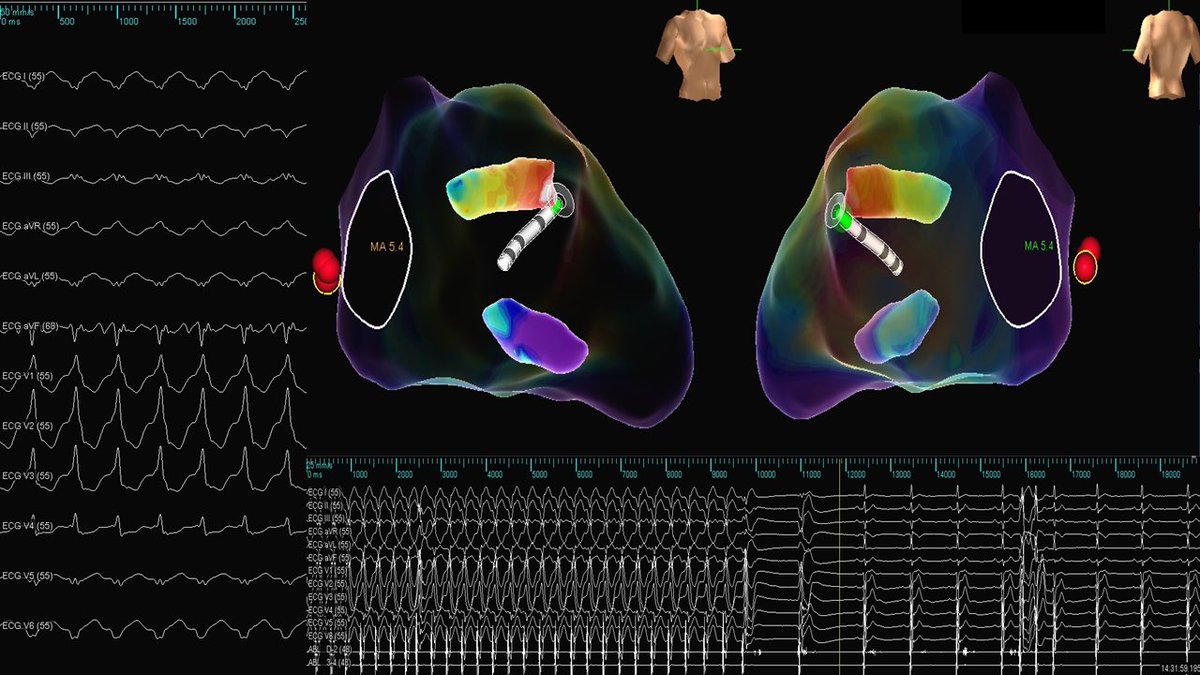 A case of AL-PAP VT  ,Intracavity structure created by PDX ( Point Density eXclusion) technique in NAVX- HD grid mapping, a useful tool when No ICE availability…a#@sabarisarav