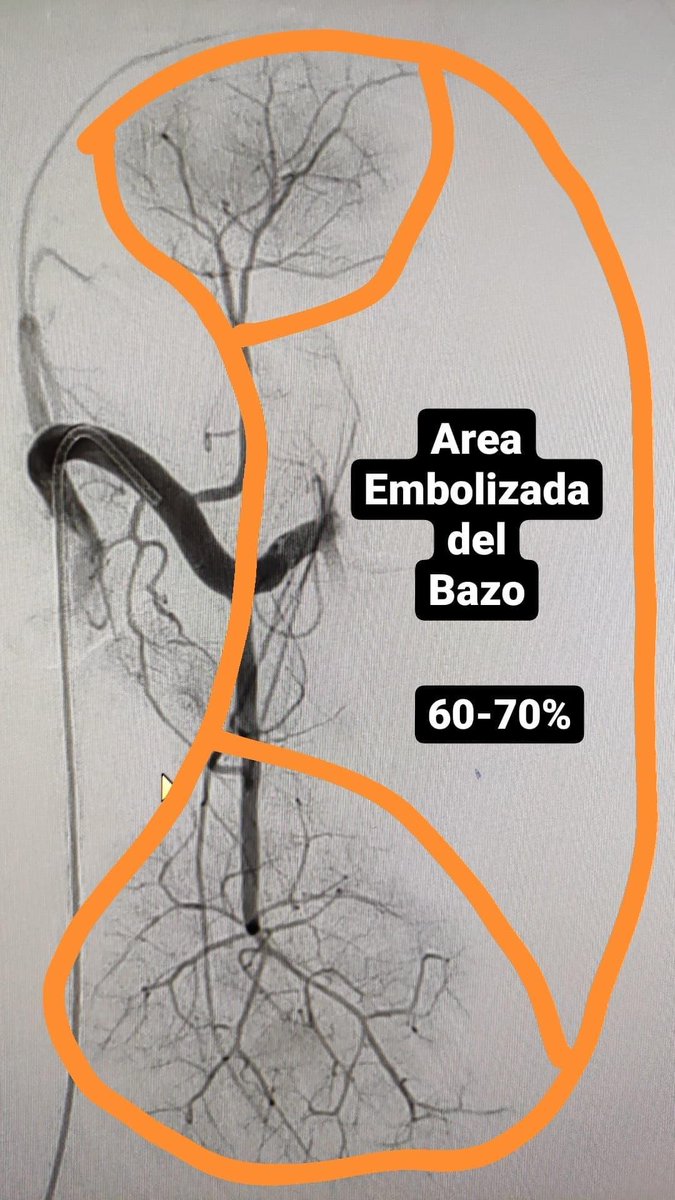 Embolización parcial del bazo.
Paciente de 10 años con Hiperesplenismo, hipertensión portal, trombocitopenia y varices gástricas ssngrantes.
Esto ayudará a disminuir tamaño y presión de la vena porta, elevar plaquetas y parar el sangrado por várices gástricas.
