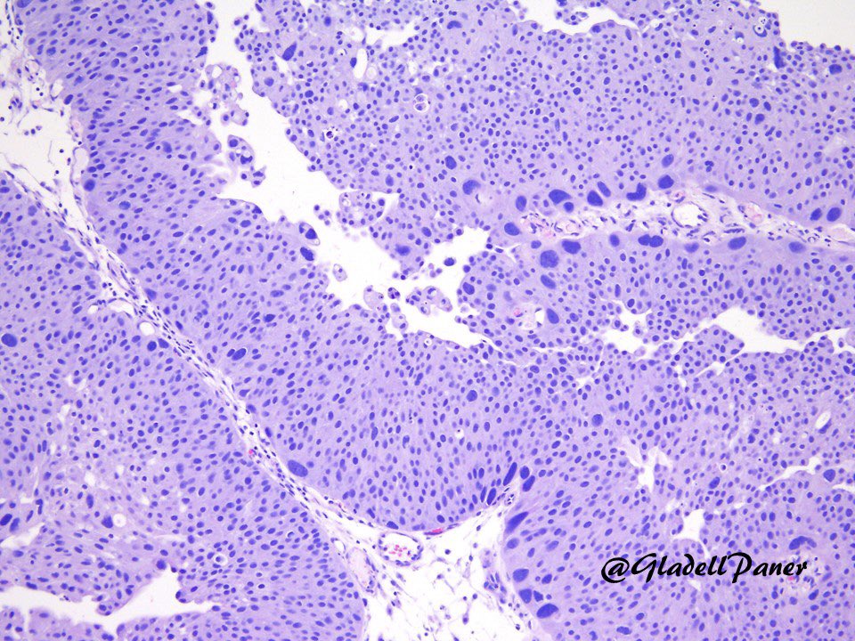 GladellPaner's tweet photo. 3 of 3. As shown there are 2 scenarios of “borderline” PUC:
1 - Morphology gray between LG & HG (so called LG/G2 vs HG/G2)
2 - Mixed LG & HG
#GradingChallenge
Case 2 - example of 1
Case 4 - example of 2
Thank you #GUPath tweeples! Last case (RCC) to follow! https://t.co/ijLdkBCsXa