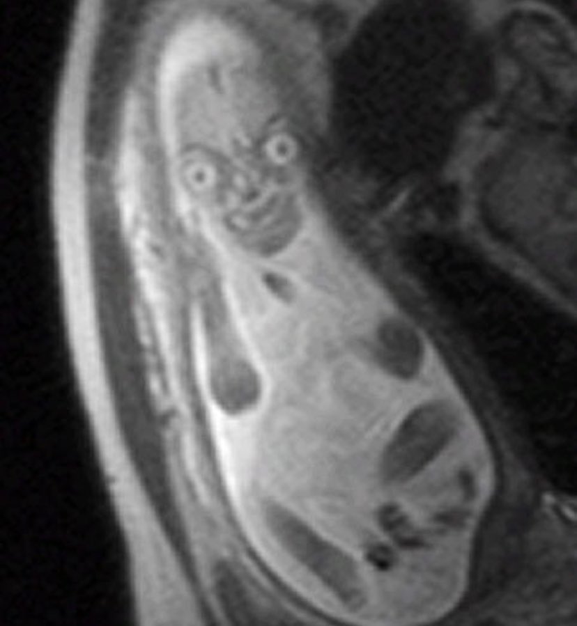 мрт беременной женщины