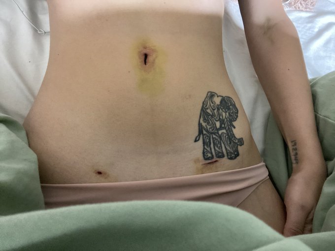 Update ? still in a lot of pain but we’re making slow progress https://t.co/hHIqTIp6lD