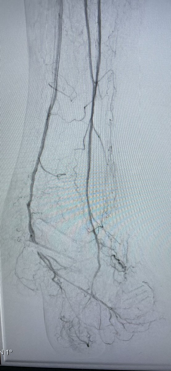 Carlos Guevara MD, FSIR (@carlosguevarair) on Twitter photo medial hallux wound, and distal 3rd, 4th toe gangrenous changes, revascularization with laser and poba, improved wound blush and toe perfusion @Saukalaka <a href="/ZagumBhatti/">Zagum Bhatti MD</a> <a href="/Sushinsk/">Sasha Ushinsky</a> <a href="/WashUIR/">Mallinckrodt IR</a> <a href="/SIRspecialists/">Society of Interventional Radiology</a> <a href="/JVIRmedia/">JVIR</a> <a href="/kmadass/">Kumar Madassery</a> <a href="/angiodynamics/">AngioDynamics, Inc.</a> <a href="/SDhandMD/">Sabeen Dhand</a> <a href="/LessneVIR/">Mark Lessne, MD</a> medial hallux wound, and distal 3rd, 4th toe gangrenous changes, revascularization with laser and poba, improved wound blush and toe perfusion @Saukalaka <a href="/ZagumBhatti/">Zagum Bhatti MD</a> <a href="/Sushinsk/">Sasha Ushinsky</a> <a href="/WashUIR/">Mallinckrodt IR</a> <a href="/SIRspecialists/">Society of Interventional Radiology</a> <a href="/JVIRmedia/">JVIR</a> <a href="/kmadass/">Kumar Madassery</a> <a href="/angiodynamics/">AngioDynamics, Inc.</a> <a href="/SDhandMD/">Sabeen Dhand</a> <a href="/LessneVIR/">Mark Lessne, MD</a>