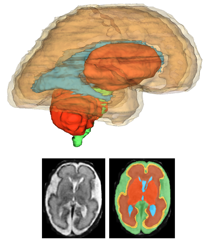 Tiny Human Brains (@andrasjakabmd) on Twitter photo Interested in how the best groups segment fetal MRI? We are proud to announce that the <a href="/FetaChallenge/">FeTAChallenge</a> has received 21 submissions, a big thank you! Remember to register for the challenge! <a href="/MiccaiS/">MICCAI</a> <a href="/MiccaiStudents/">MICCAI Students</a> <a href="/PIPPIworkshop/">PIPPI</a> miccai2021.org/en/REGISTRATIO… Interested in how the best groups segment fetal MRI? We are proud to announce that the <a href="/FetaChallenge/">FeTAChallenge</a> has received 21 submissions, a big thank you! Remember to register for the challenge! <a href="/MiccaiS/">MICCAI</a> <a href="/MiccaiStudents/">MICCAI Students</a> <a href="/PIPPIworkshop/">PIPPI</a> miccai2021.org/en/REGISTRATIO…