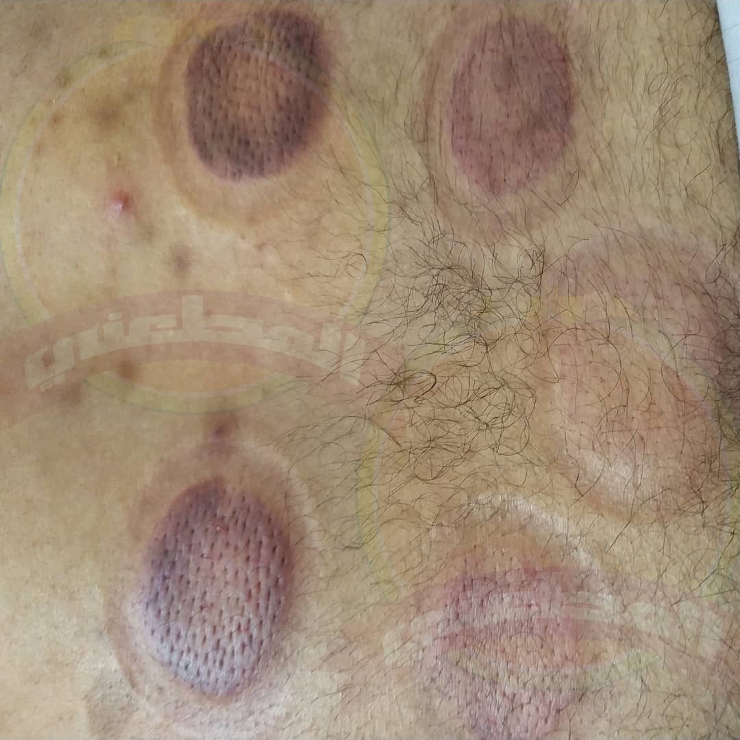 AlmtanyHijama's tweet photo. #جلسة_حجامة_على_الماشي
الحجامة فيها #فائدة عظيمة

مركز المطعني للحجامة
خبرة أكثر من 9 سنوات ولله الحمد
 #آلام_العظام #العمود_الفقري #غضروف #فقرات_الظهر #القطنية #فقرات_الرقبة #الخشونة #آلام_المفاصل #الركبة #الكتف #الحجامة #إلتهاب_الأعصاب #إلتهابات #المناعة
#سم_النحل #خبرة_9_سنوات https://t.co/HrjXbudjhu