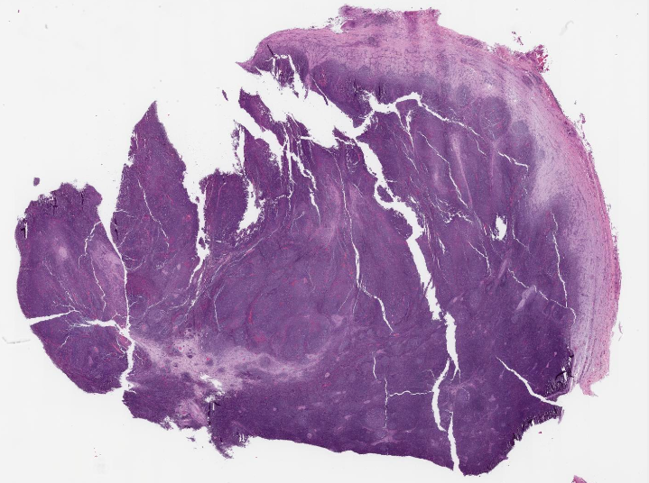 SibaElHussein's tweet photo. #LessonsfromtheFridayUnknowns Pediatric-type FL: "A node in a node", case shown to us by @ljmedeirosMD during #LJMFridayUnknowns➡️ https://t.co/1FODtYfWny

#hemepath #PathTwitter #lymsm 

@KirillLyapichev @RMirandaMD @Xiaoqiong_Wang @LianqunQiu @SkybhatiaMD @Dowhankim https://t.co/wG7CKfDmm4