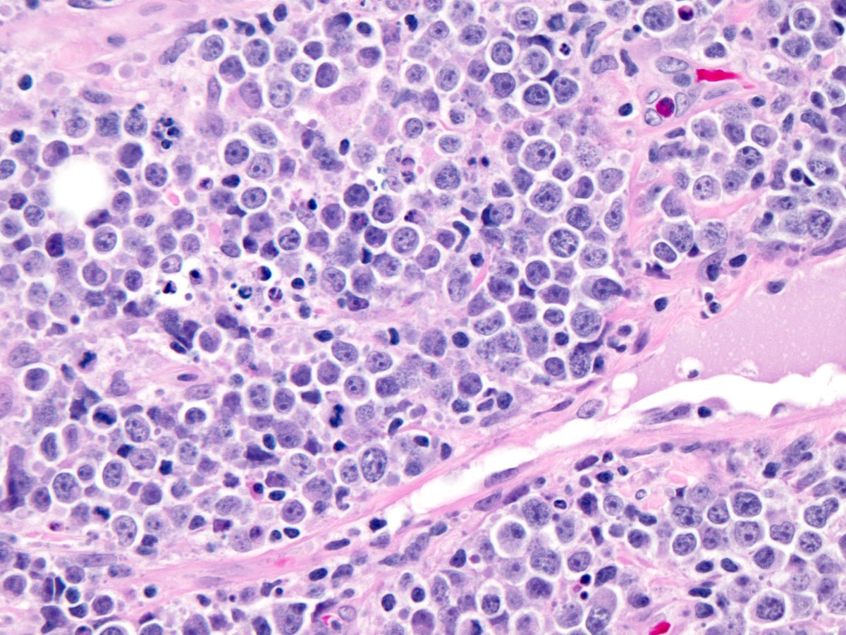 Merkel Cell Tumour Pathology Outlines - PeteBridget