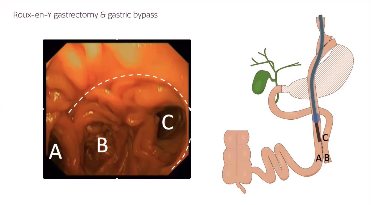 tberzin's tweet photo. A helpful but *very subtle* teaching point for those performing enteroscopy or ERCP in Roux-en-Y anatomy

In hepaticojej ➡️ cross JJ suture line, biliary limb is continuous w/common (enteral) limb

In gastric bypass ➡️ cross JJ suture line, biliary limb is continuous w/blind end https://t.co/rZ8QkckJtS